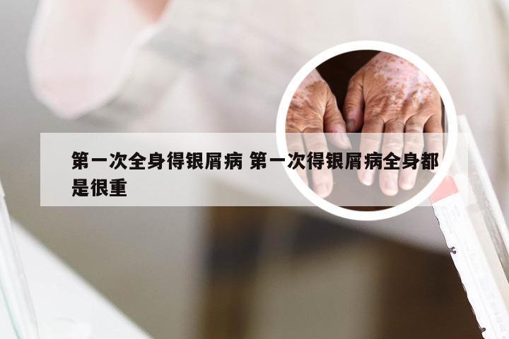 第一次全身得银屑病 第一次得银屑病全身都是很重
