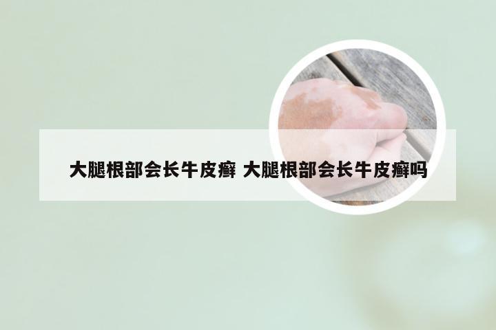 大腿根部会长牛皮癣 大腿根部会长牛皮癣吗