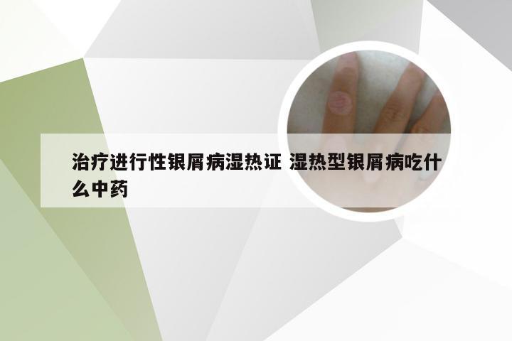 治疗进行性银屑病湿热证 湿热型银屑病吃什么中药