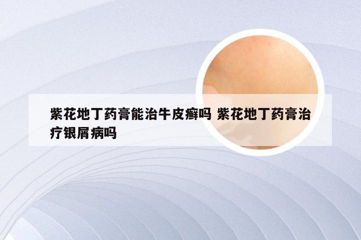 紫花地丁药膏能治牛皮癣吗 紫花地丁药膏治疗银屑病吗