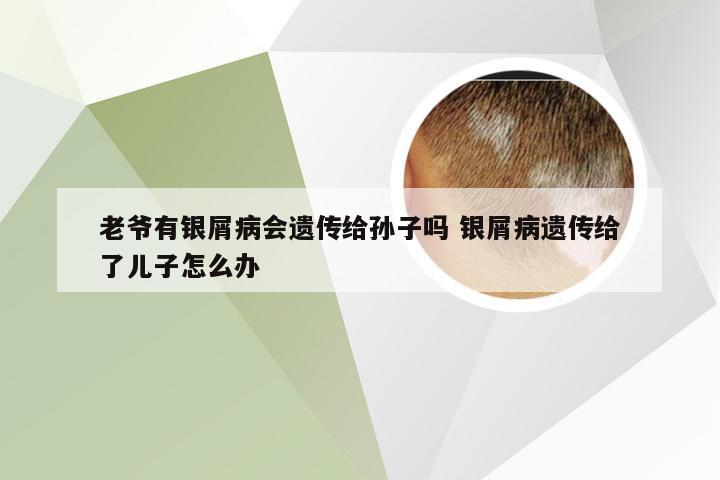 老爷有银屑病会遗传给孙子吗 银屑病遗传给了儿子怎么办