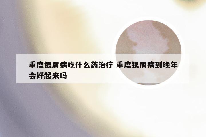 重度银屑病吃什么药治疗 重度银屑病到晚年会好起来吗