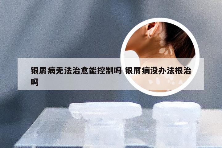 银屑病无法治愈能控制吗 银屑病没办法根治吗