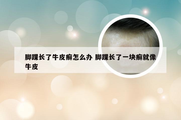 脚踝长了牛皮癣怎么办 脚踝长了一块癣就像牛皮
