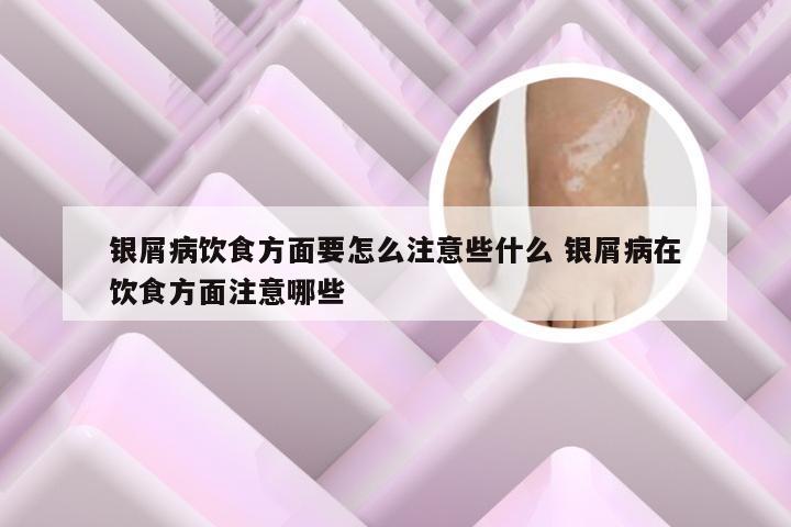 银屑病饮食方面要怎么注意些什么 银屑病在饮食方面注意哪些