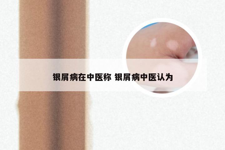 银屑病在中医称 银屑病中医认为