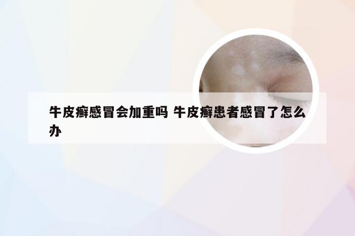 牛皮癣感冒会加重吗 牛皮癣患者感冒了怎么办