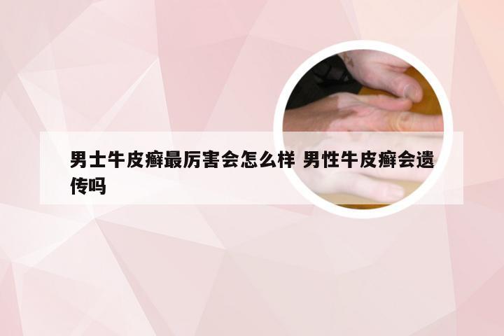 男士牛皮癣最厉害会怎么样 男性牛皮癣会遗传吗