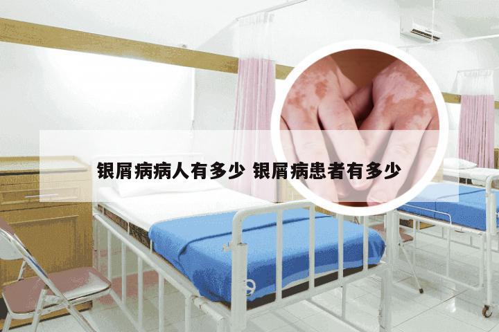 银屑病病人有多少 银屑病患者有多少