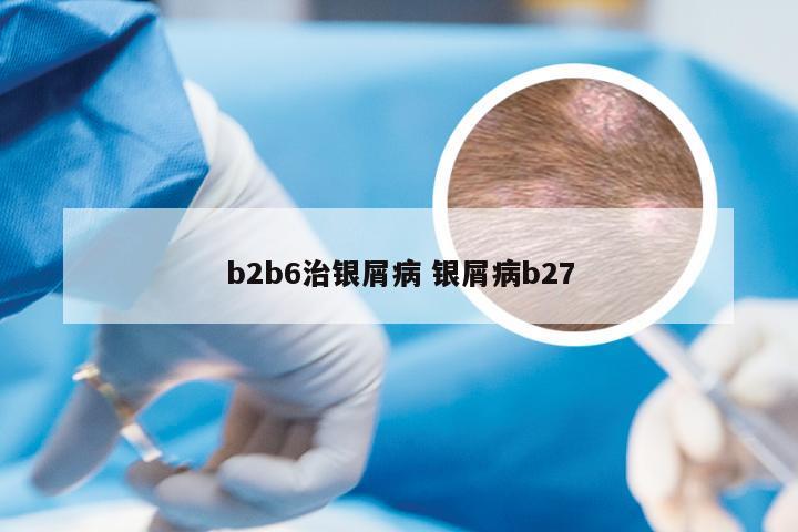 b2b6治银屑病 银屑病b27