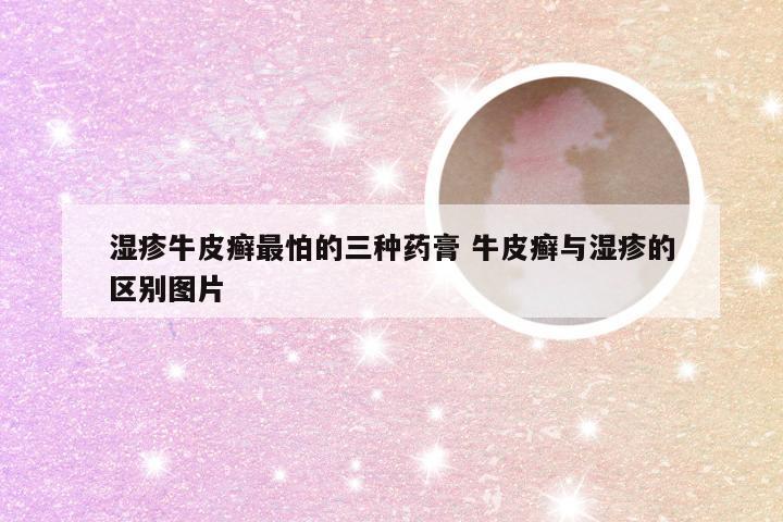 湿疹牛皮癣最怕的三种药膏 牛皮癣与湿疹的区别图片