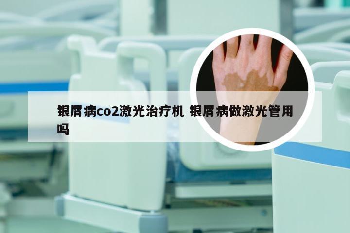 银屑病co2激光治疗机 银屑病做激光管用吗