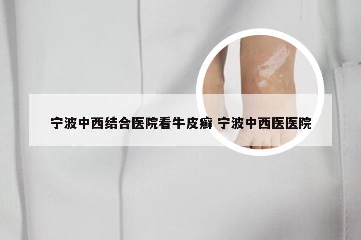 宁波中西结合医院看牛皮癣 宁波中西医医院