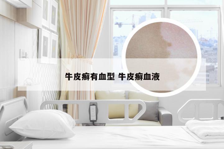 牛皮癣有血型 牛皮癣血液