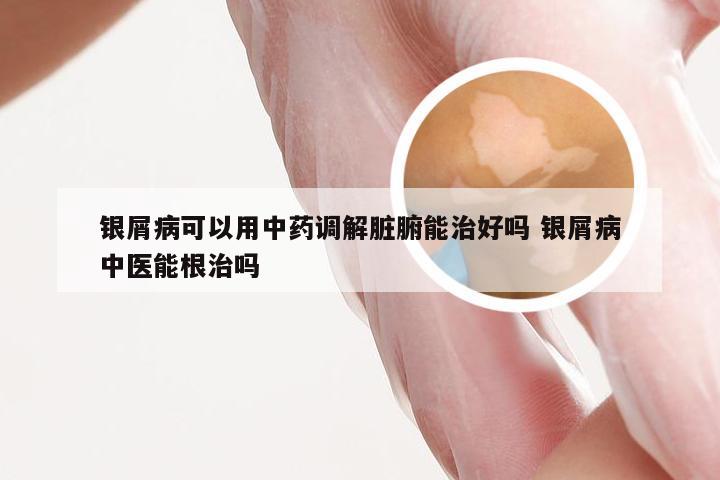 银屑病可以用中药调解脏腑能治好吗 银屑病中医能根治吗