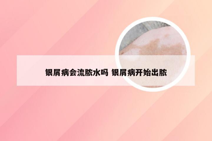 银屑病会流脓水吗 银屑病开始出脓