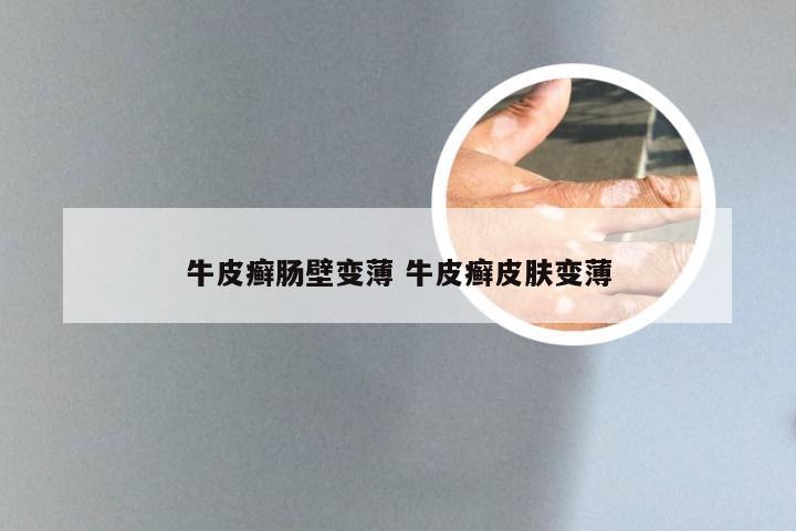 牛皮癣肠壁变薄 牛皮癣皮肤变薄