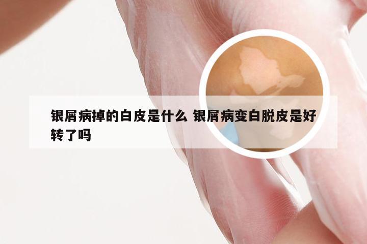 银屑病掉的白皮是什么 银屑病变白脱皮是好转了吗