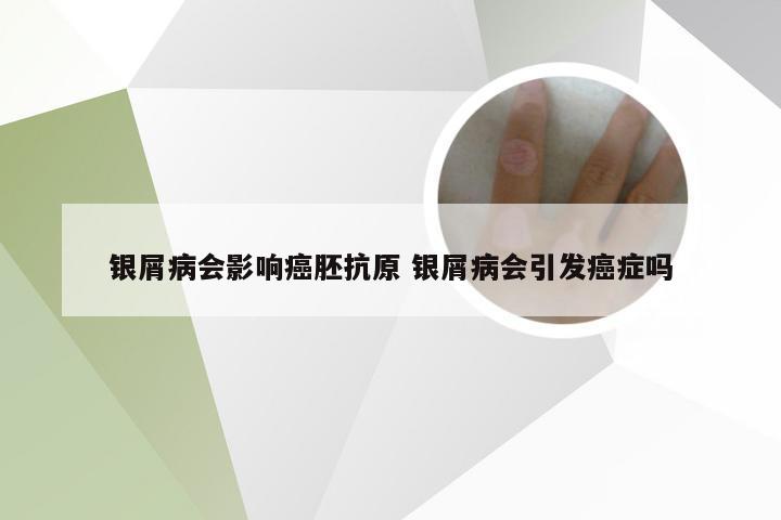 银屑病会影响癌胚抗原 银屑病会引发癌症吗