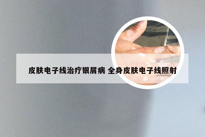皮肤电子线治疗银屑病 全身皮肤电子线照射