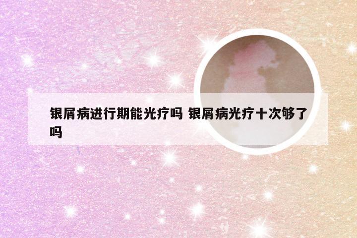 银屑病进行期能光疗吗 银屑病光疗十次够了吗