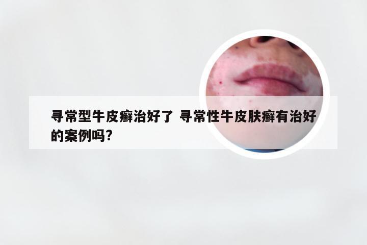 寻常型牛皮癣治好了 寻常性牛皮肤癣有治好的案例吗?