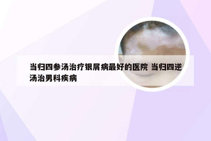 当归四参汤治疗银屑病最好的医院 当归四逆汤治男科疾病