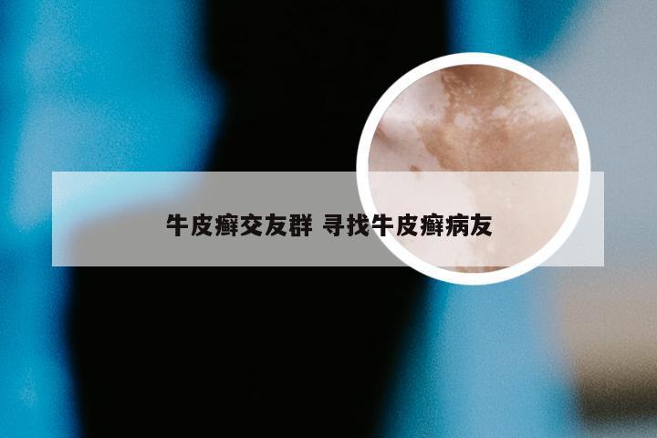 牛皮癣交友群 寻找牛皮癣病友
