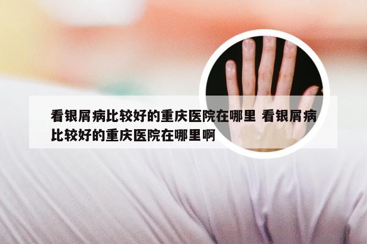 看银屑病比较好的重庆医院在哪里 看银屑病比较好的重庆医院在哪里啊