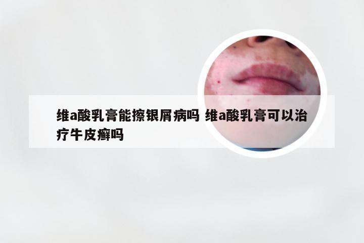 维a酸乳膏能擦银屑病吗 维a酸乳膏可以治疗牛皮癣吗