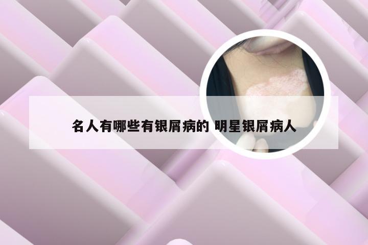 名人有哪些有银屑病的 明星银屑病人
