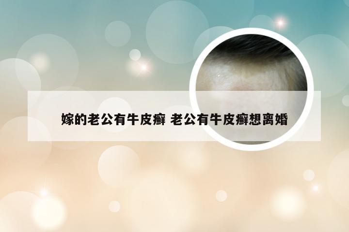 嫁的老公有牛皮癣 老公有牛皮癣想离婚