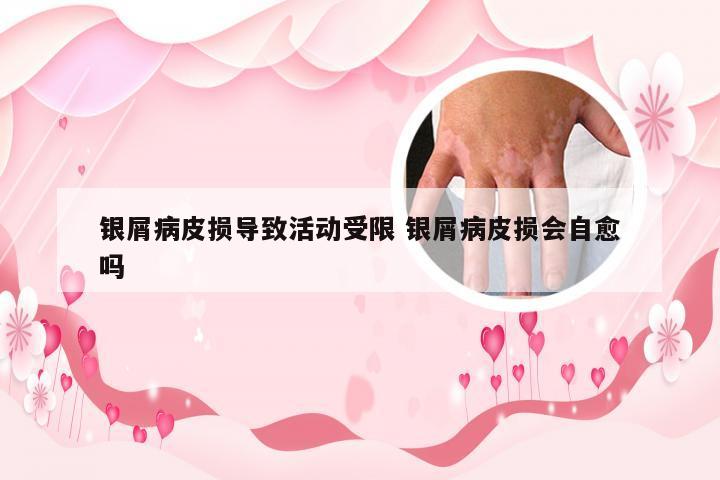 银屑病皮损导致活动受限 银屑病皮损会自愈吗