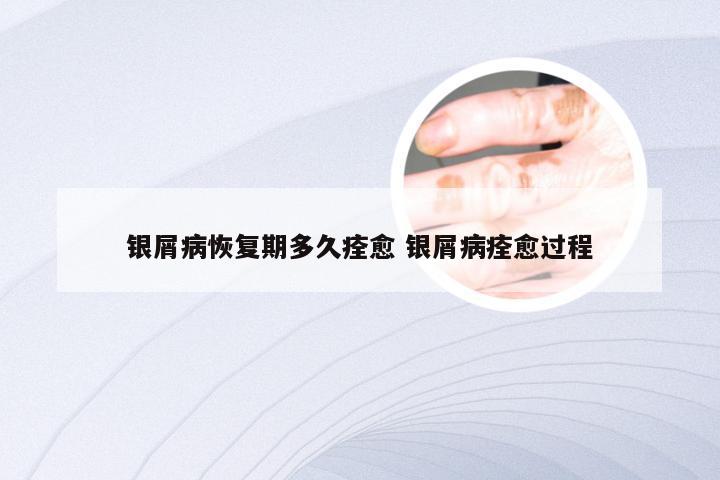 银屑病恢复期多久痊愈 银屑病痊愈过程