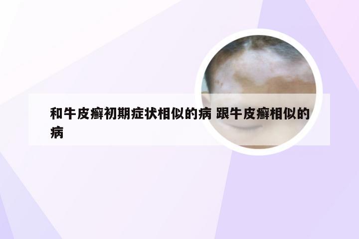 和牛皮癣初期症状相似的病 跟牛皮癣相似的病
