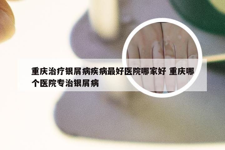 重庆治疗银屑病疾病最好医院哪家好 重庆哪个医院专治银屑病