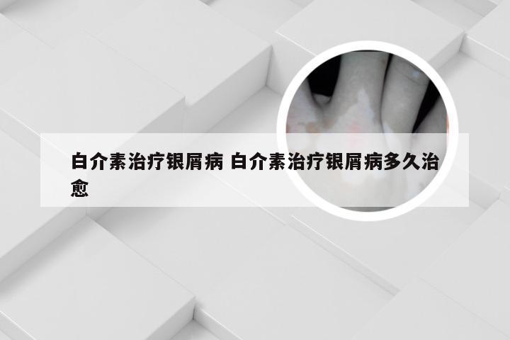 白介素治疗银屑病 白介素治疗银屑病多久治愈
