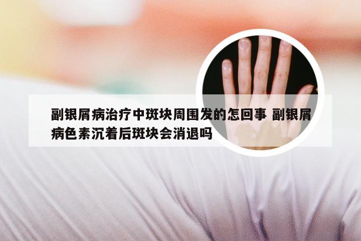 副银屑病治疗中斑块周围发的怎回事 副银屑病色素沉着后斑块会消退吗