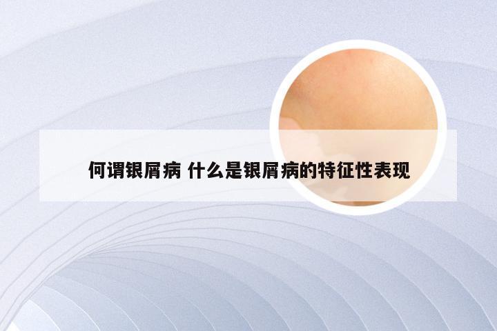 何谓银屑病 什么是银屑病的特征性表现