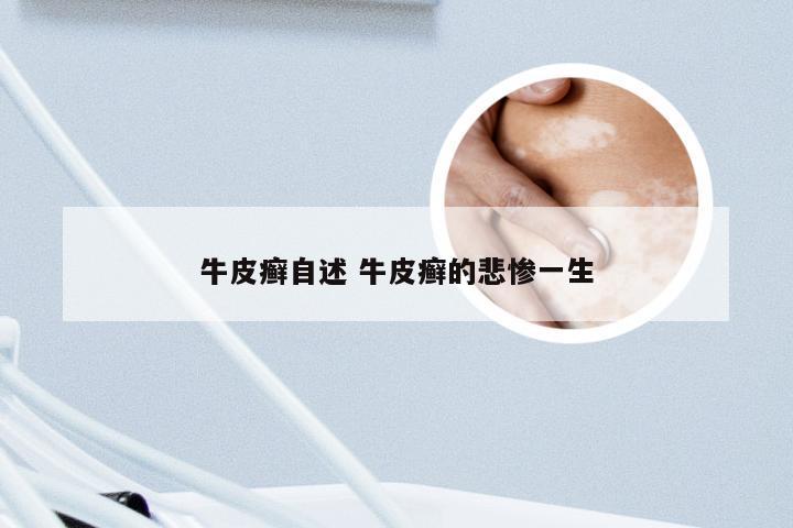 牛皮癣自述 牛皮癣的悲惨一生