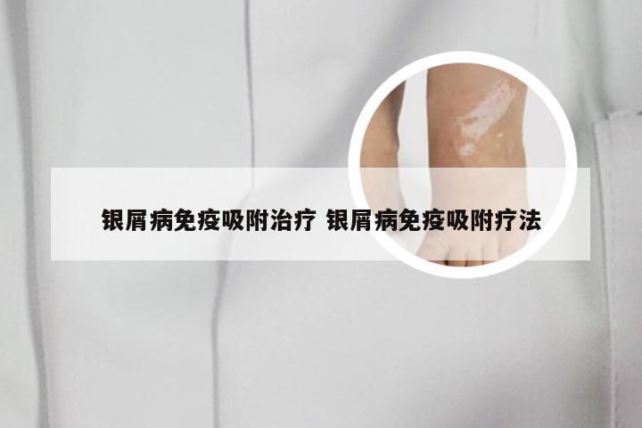 银屑病免疫吸附治疗 银屑病免疫吸附疗法