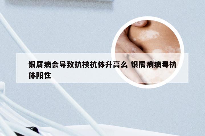 银屑病会导致抗核抗体升高么 银屑病病毒抗体阳性