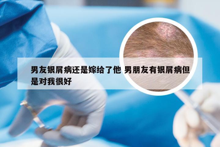 男友银屑病还是嫁给了他 男朋友有银屑病但是对我很好