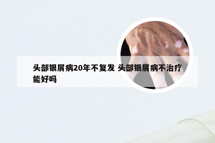 头部银屑病20年不复发 头部银屑病不治疗能好吗