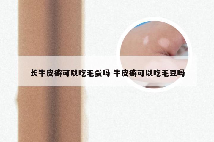 长牛皮癣可以吃毛蛋吗 牛皮癣可以吃毛豆吗