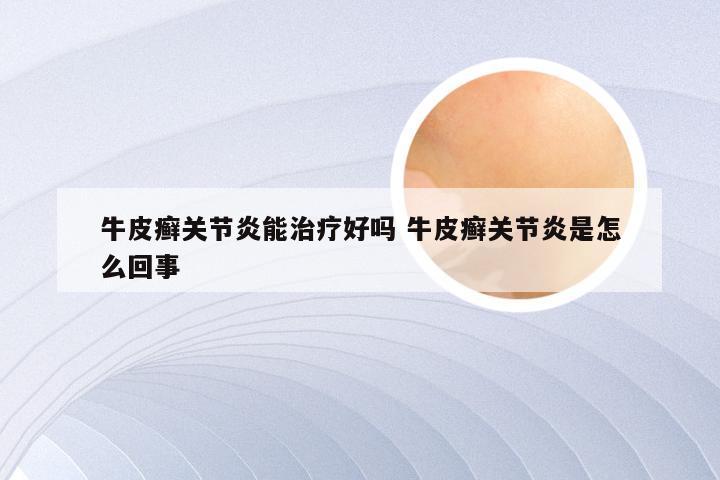 牛皮癣关节炎能治疗好吗 牛皮癣关节炎是怎么回事