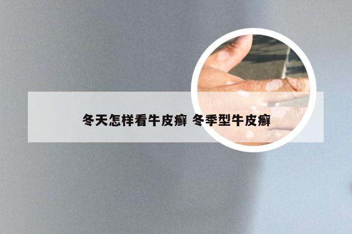 冬天怎样看牛皮癣 冬季型牛皮癣