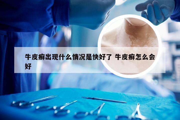 牛皮癣出现什么情况是快好了 牛皮癣怎么会好