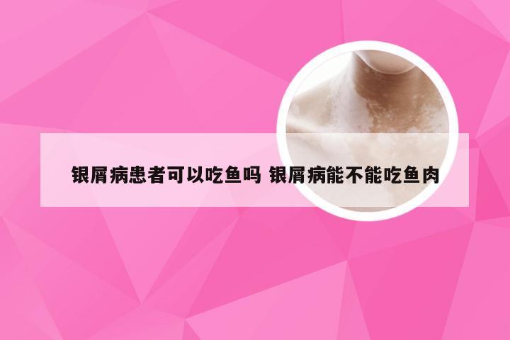 银屑病患者可以吃鱼吗 银屑病能不能吃鱼肉