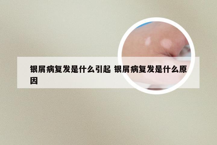 银屑病复发是什么引起 银屑病复发是什么原因